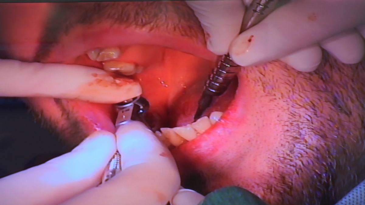practiculum-implantologii-s6-e6-347